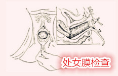处女膜修复检查